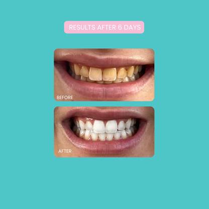 Smilie Boost Teeth Whitening Kit - Developed By Dentists
