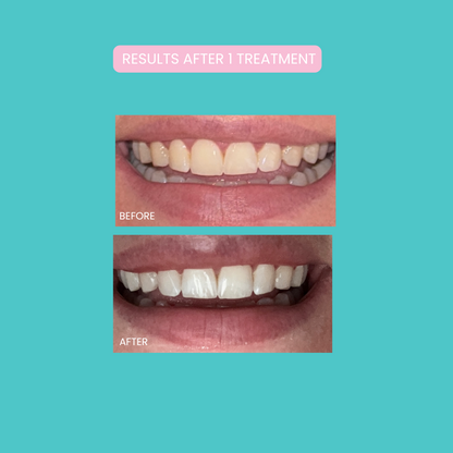 Smilie Boost Teeth Whitening Kit - Developed By Dentists