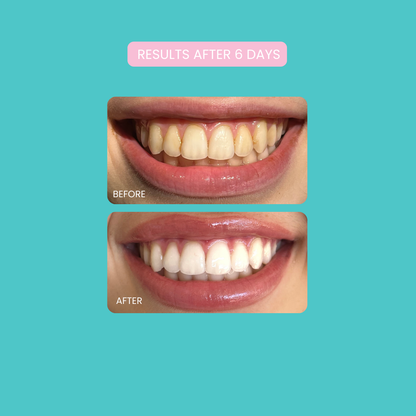 Smilie Boost Teeth Whitening Kit - Developed By Dentists