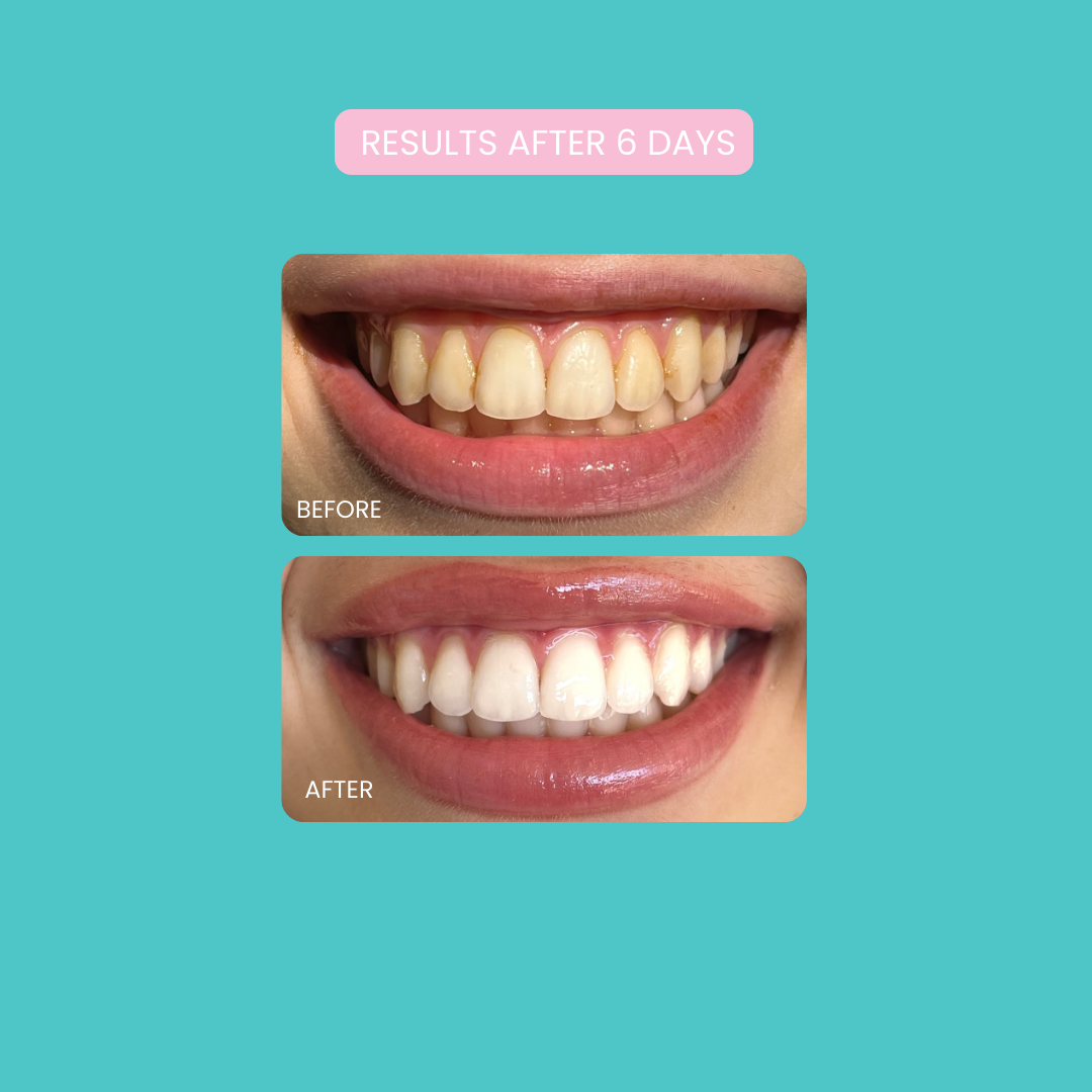 Smilie Boost Teeth Whitening Kit - Developed By Dentists